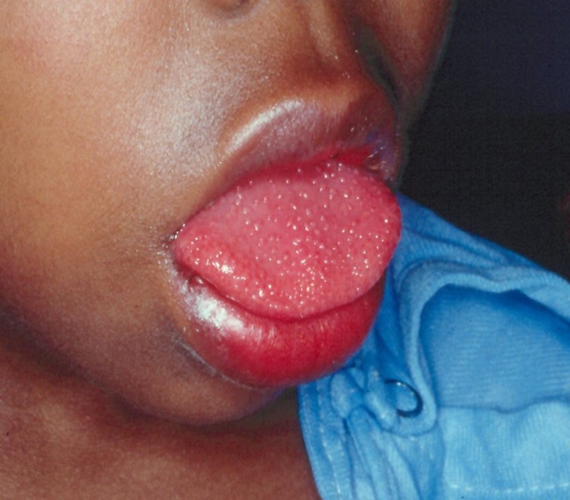 strawberry tounge