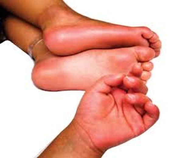 swollen feets
