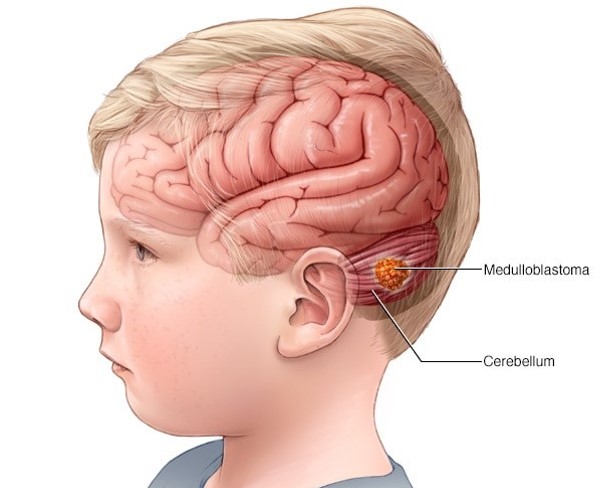 medullo